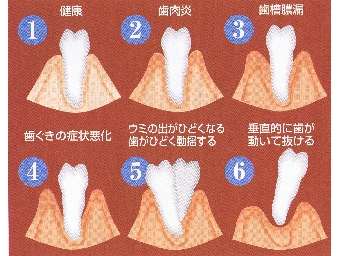 歯周病・歯槽膿漏