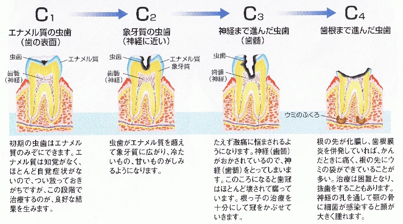 虫歯の進み方