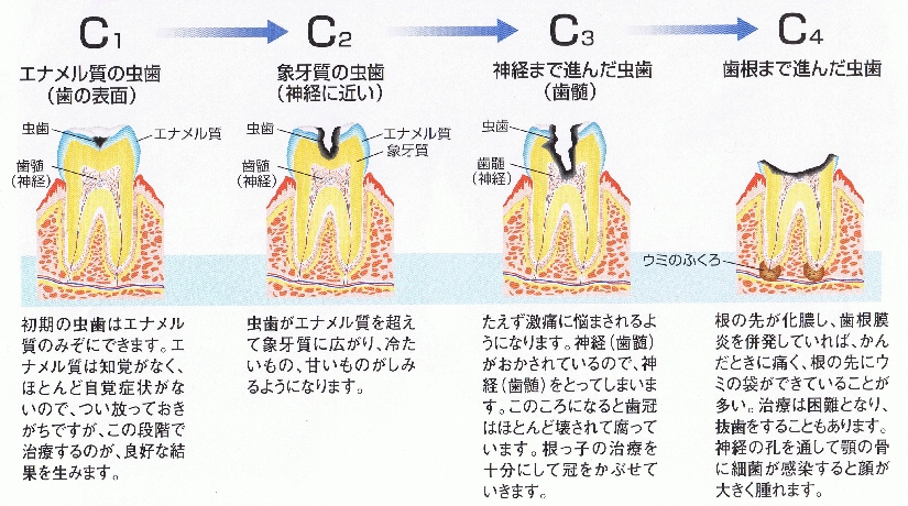 早期発見！早期治療！虫歯の進み方